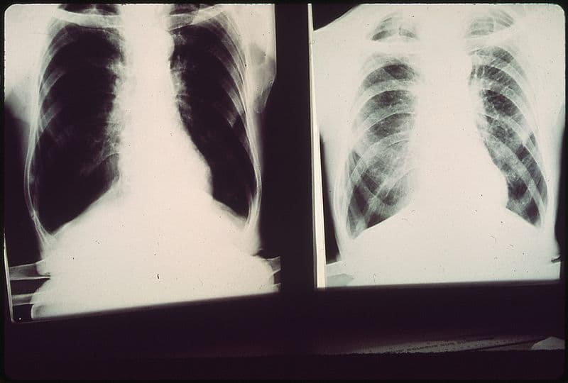 Black Lung Xray Images